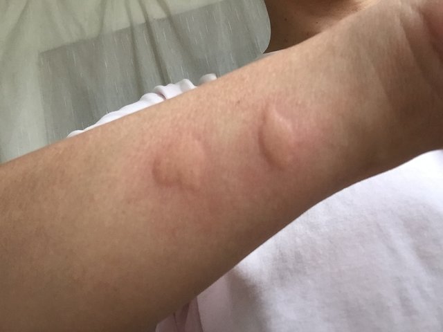 na ukąszenie komara 